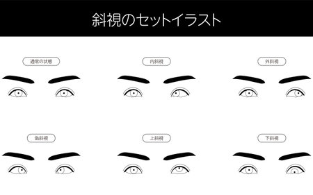 Medical illustration, Illustrative set eye diseases and strabismus - Translation: Clip art of strabismus set, normal, Esotropia, Exotropia, Pseudostrabismus, Hypertropia, Hyportropiaのイラスト素材
