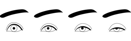 Medical Illustration, Ptosis Symptoms Normal to Severe - Translation: When opening the eyes, the white part above the iris is visible. When opening the eyes, the eyelid covers the iris but not the pupil. Even when opening the eyes, part of the pupil is hidden. Even when opening the eyes, more than half of the pupil is hidden.のイラスト素材