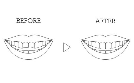 Cosmetic dentistry, direct bonding before and after, chipped tooth, Vector Illustrationのイラスト素材