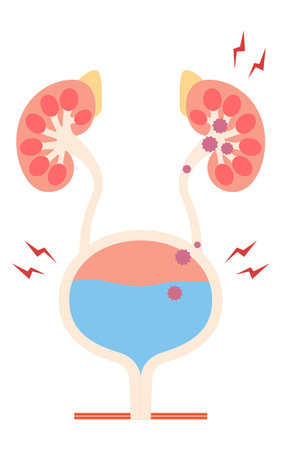 Medical illustration of pyelonephritis, the backflow of bacteria from the bladder to the kidneys, Vector Illustrationのイラスト素材