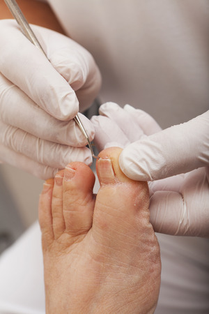 A chiropodist works with a Toenail Lifterの写真素材