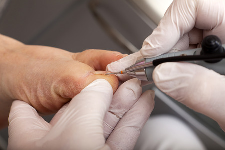 Podiatrist works with a grinding machineの写真素材