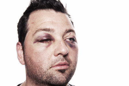 eye injury, male with black eye isolated on white. man after accident or fight with bruise