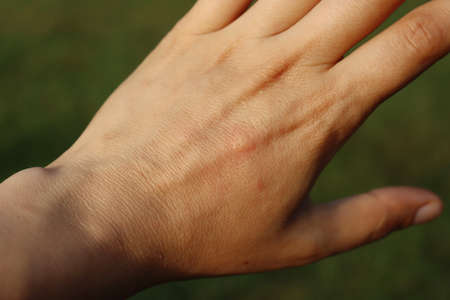 Mosquito bite on a female adult hand on a green meadow backgroundの写真素材