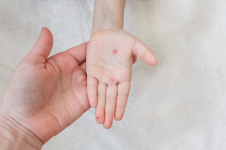 The hand of a child with chickenpox in her mother's hand. Blisters on the hand from chickenpoxの写真素材