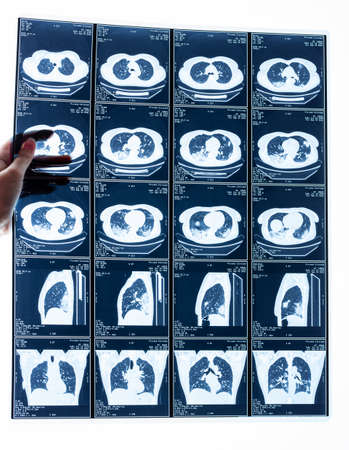 Girl holding X-ray diagnosis of sick man covid 19の写真素材
