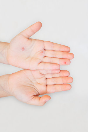 Childs hands with chickenpox wounds on a gray background. Disease preventionの写真素材