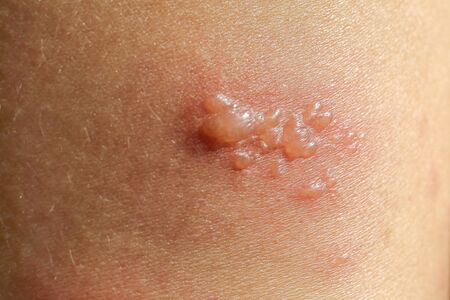 skin rash as allergic symptoms due to arm fiberglass castの写真素材