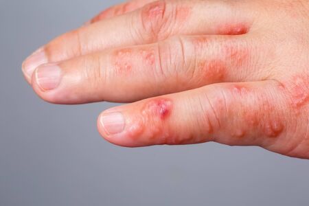 Shingles, Zoster or Herpes Zoster symptoms on armの写真素材