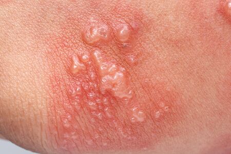 Shingles, Zoster or Herpes Zoster symptoms on armの写真素材