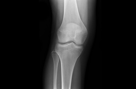 Knee Joints of an Adolescent via X-Rayの写真素材