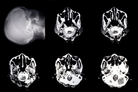 images from computed tomography (CT scan) of the brainの写真素材