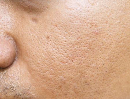 pores and oily on surface young asian man face skin do not take care for a long timeの写真素材