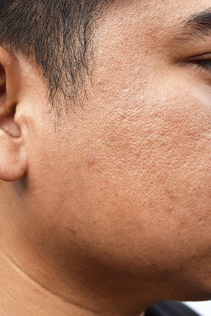 pores and oily on surface young asian man face skin do not take care for a long timeの写真素材