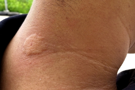 man neck after bee stings