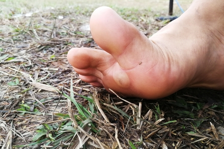 swollen under feet after walk all dayの写真素材