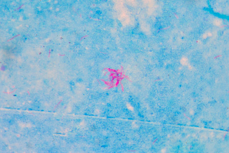 red Mycobacterium tuberculosis on blue background.