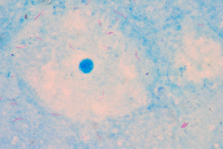 red Mycobacterium tuberculosis on blue background.