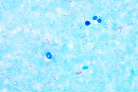 Slide Positive acid fast bacilli.