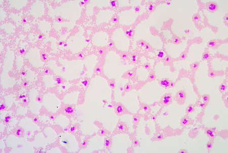 White blood cells of a human, photomicrograph panorama as seen under the microscope, 100x zoom.