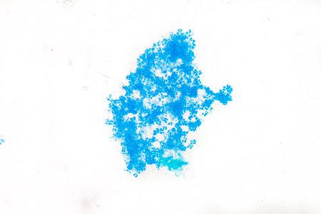gram positive cocci in sputum smear.