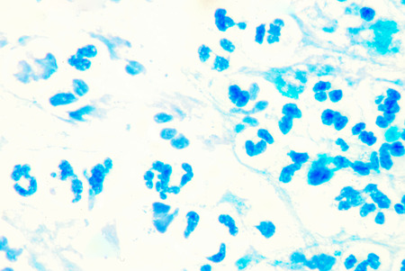 Leukocyte in sputum smear.