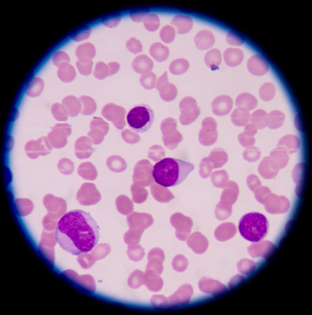 A blood smear is often used as a follow-up test to abnormal results on a complete blood count (CBC) to evaluate the different types of blood cells.の写真素材