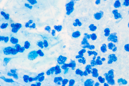 white blood cell in sputum AFB.