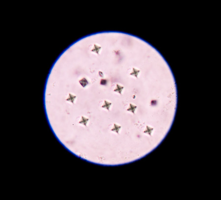 Calcium oxalate in urine analysis.