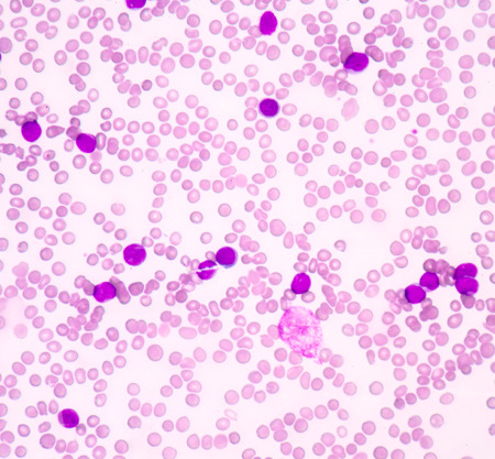 Blood smear  show acute myeloblastic leukemia(AML).The smear shows large number of cancer leukemia...