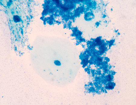 Blue squamous cell with bacteria.