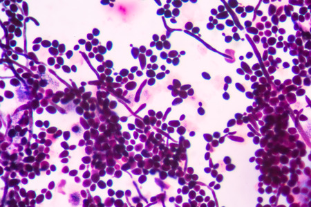budding yeast cells with pseudohyphae in urine gram stain  fine with microscope.の写真素材