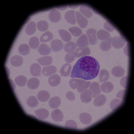 Atypical, or reactive, lymphocytes are lymphocytes that, as a result of antigen stimulation, have become quite large, sometimes more than 30 Âµm in diameter. The cells vary greatly in size and shape.の写真素材