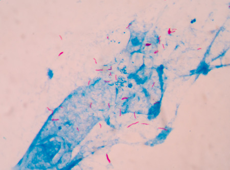 Bacterial infection tuberculosis.red cells in blue background.AFB 3+ fine with microscope.の写真素材