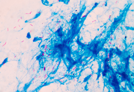 Bacterial infection tuberculosis.red cells in blue background.AFB 3+ fine with microscope.の写真素材