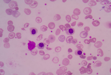 blood smear thalassemia showing hypochromia,schistocyte,NRC,Target cells,の写真素材
