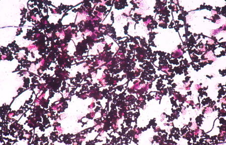 Branching budding yeast cells with pseudohyphae in urine gram stain fine with microscope.