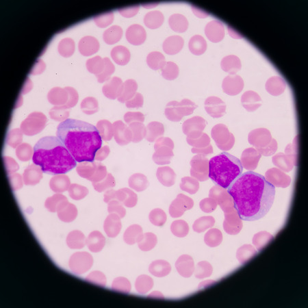 blood smear is often used as a follow-up test to abnormal results on a complete blood count (CBC) to evaluate the different types of blood cells.Medical science background showing blast cells(AML)