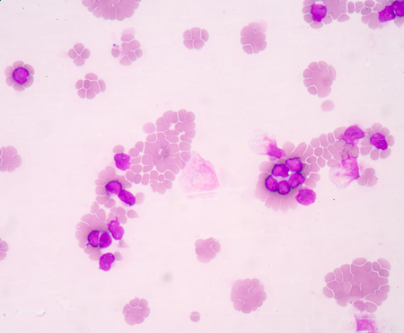 blood smear is often used as a follow-up test to abnormal results on a complete blood count (CBC) to evaluate the different types of blood cells.Medical science background showing blast cells(AML)の写真素材