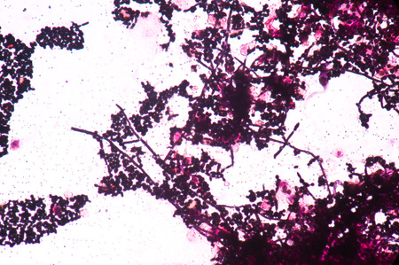 Branching budding yeast cells with pseudohyphae in urine gram stain fine with microscope.