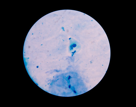 Bacteria in sputum gram stain fine wit microscope.