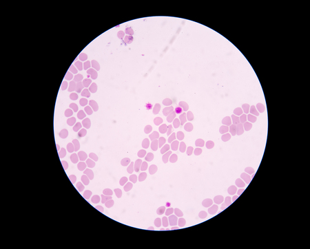 Giant platelet disorders are rare disorders featuring abnormally large platelets, thrombocytopenia and a tendency to bleeding. Giant platelet disorder occurs for inherited diseases like Bernard-Soulier syndrome, gray platelet syndrome and May-Hegglin anom
