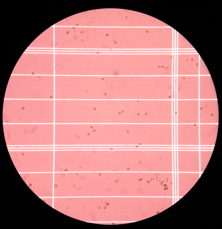Fresh red blood  cells in CSF fluid sample on scale counting chamber.