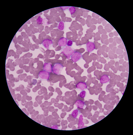 The most common problem with malfunctioning myeloblasts is acute myeloblastic leukemia. The main...