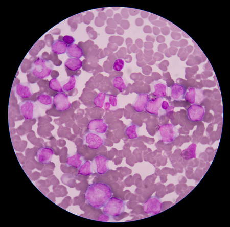 The most common problem with malfunctioning myeloblasts is acute myeloblastic leukemia. The main...