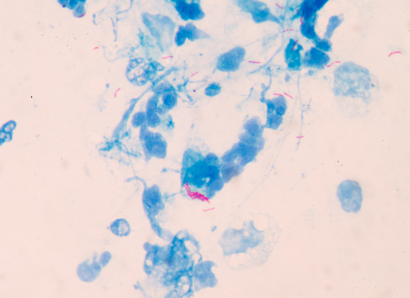 Micro bacterium tuberculosis 3+ moderate red cells on blue background .Medical science background...