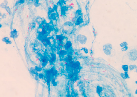 Micro bacterium tuberculosis 3+ moderate red cells on blue background .Medical science background concept.の写真素材