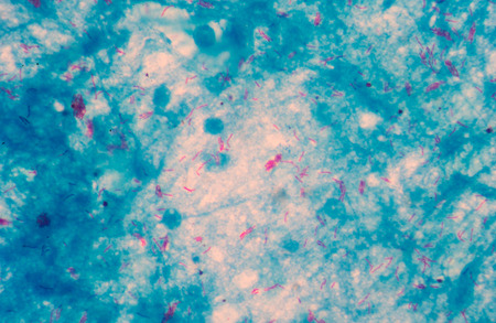 Micro bacterium tuberculosis 3+ moderate red cells on blue background .Medical science background...