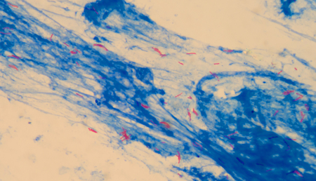 mycobacterium tuberculosis (3+)moderat red cells on blue background.