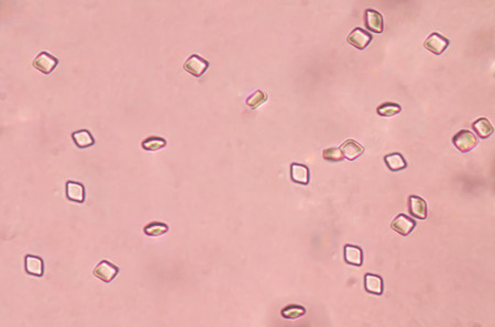Uric acid crystal in urine sediment.の写真素材